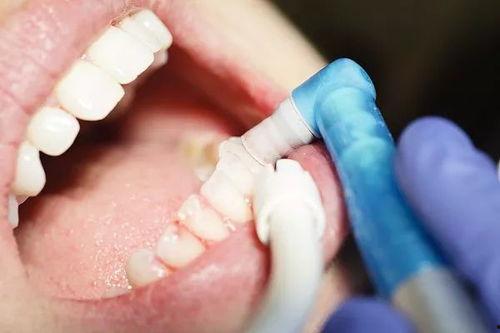 成人全麻补牙过程视频,轻松舒适,告别恐惧